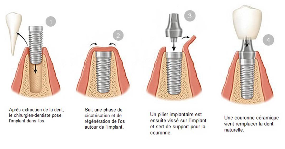 D'Email et D'Ivoire - Laboratoire de Prothèse dentaire - Implants