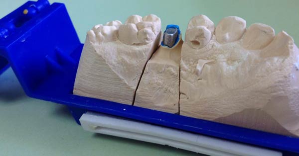 D'Email et D'Ivoire - Laboratoire de Prothèse dentaire - Inlay core et faux moignons